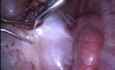 Enlèvement de kyste dermoïde laparoscopique