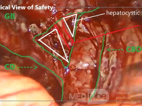 Vue Critique de la Sécurité dans la Cholécystectomie Laparoscopique