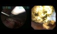 Exploration laparoscopique du conduit cholédoque par un interne de chirurgie mini-invasive avec élimination de 45 calculs intra- et extra-hépatiques.
