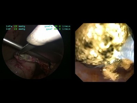 Exploration laparoscopique du conduit cholédoque par un interne de chirurgie mini-invasive avec élimination de 45 calculs intra- et extra-hépatiques.