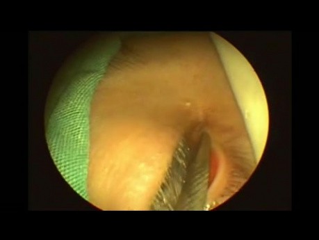 Dacryocystorhinostomie endoscopique sans stents