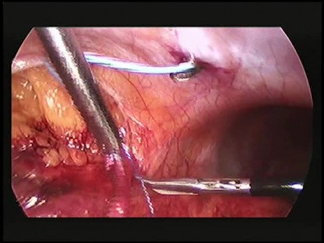 Uretère rétrocave: transposition laparoscopique de l'uretère rétrocave et une anastomose urétéro-urétérale