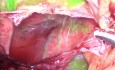 Chirugie Laparoscopique D'un Kyste Hépatique Guidée Par La Fluorescence Au Vert D'indocyanine (ICG)