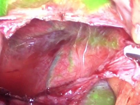 Chirugie Laparoscopique D'un Kyste Hépatique Guidée Par La Fluorescence Au Vert D'indocyanine (ICG)