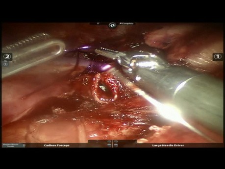 Tumeur carcinoïde - chirurgie robot-assistée