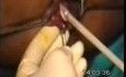 Cryochirurgie des hémorroïdes.