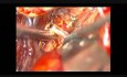 Anévrisme Cérébral - Bifurcation de l'Artère Cérébrale Moyenne - Clipping Microchirurgical