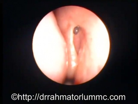 Dacryo-cysto-rhinostomie Endoscopique Réussie - Vue Postopératoire