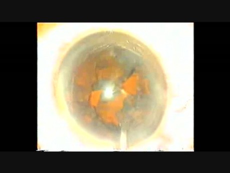 Cataracte avec opacification capsulaire postérieur OCP