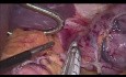 Résection Coelioscopique de GIST Fundique (Tumeur Stromale Gastro-intestinale)