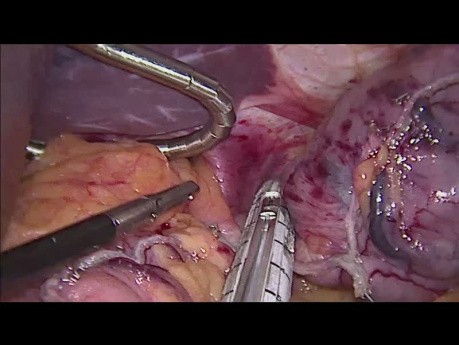 Résection Coelioscopique de GIST Fundique (Tumeur Stromale Gastro-intestinale)