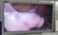 Douleur Pelvienne: Hydrosalpinx Géant Adhérant à la Paroi Abdominale