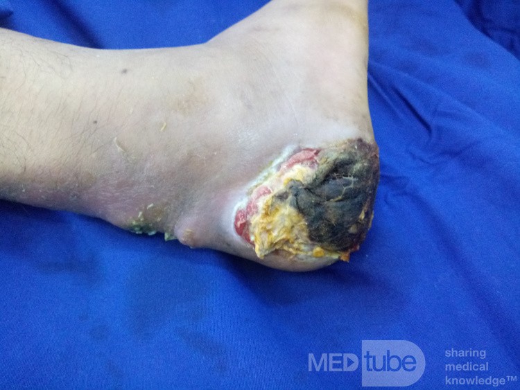 Ulcère du talon diabétique avec infection du tendon d'Achille