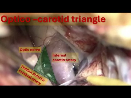Trianglo Ophtalmo-Carotidien