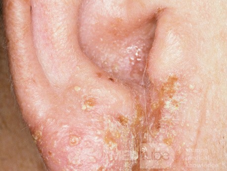 Dermatite de contact à la néomycine