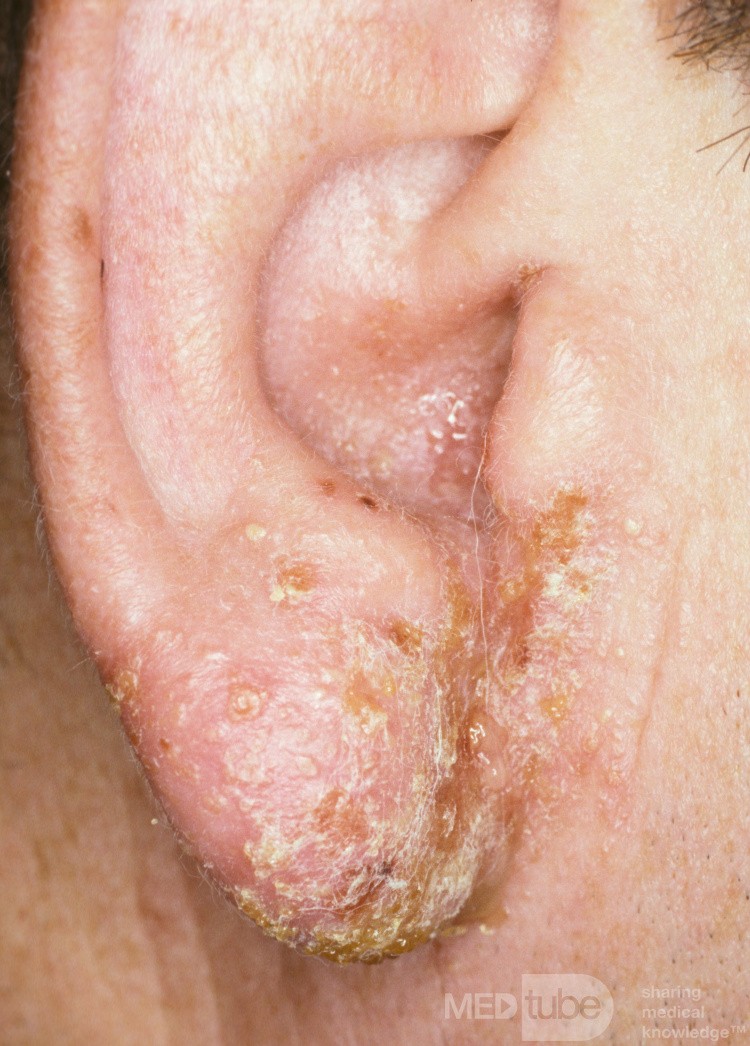 Dermatite de contact à la néomycine