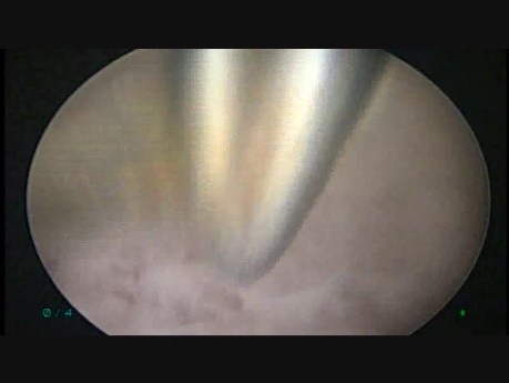 Section d'une cloison utérine aux ciseaux lors d'une hystéroscopie