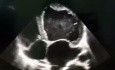 7. Cas d'échocardiographie - Qu'est-ce que vous voyez ?