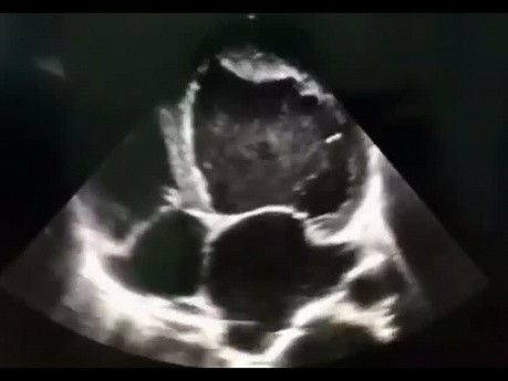 7. Cas d'échocardiographie - Qu'est-ce que vous voyez ?