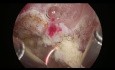 Résection Laparoscopique de Fibrome