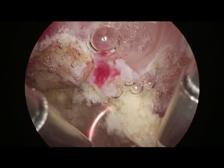 Résection Laparoscopique de Fibrome