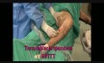 RFITT Celon - la dernière méthode de traitement de l'insuffisance veineuse