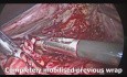 Fundoplicature avec cardiomyotomie de Heller par voie laparoscopique