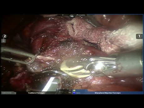 Segmentectomie pulmonaire anatomique S2 assistée par robot