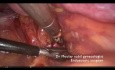 Ligature de l'artère iliaque interne et myomectomie