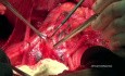 Lymphadénectomie para-aortique ouverte