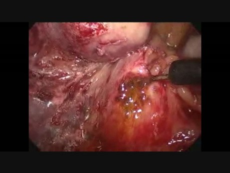 Exploration laparoscopique du canal cholédoque (après une cholécystectomie)