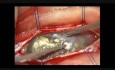 Kyste Épidermoïde Intra-Dural Rachidien - Ablation Microchirurgicale