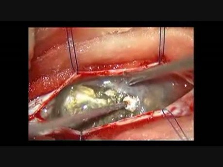 Kyste Épidermoïde Intra-Dural Rachidien - Ablation Microchirurgicale