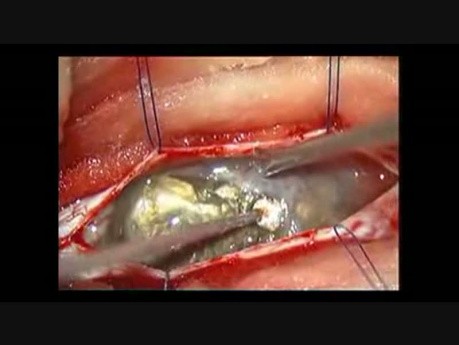 Kyste Épidermoïde Intra-Dural Rachidien - Ablation Microchirurgicale