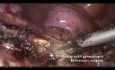 Hystérectomie laparoscopique totale pour utérus énorme - trucs et astuces