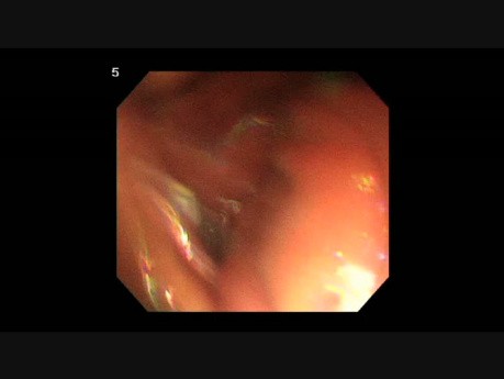 DSM d'une tumeur sous-muqueuse gastrique