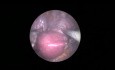 L'hystérectomie laparoscopique par orifice unique de 8,5 mm