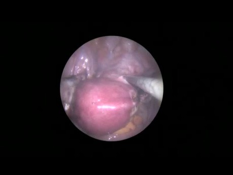L'hystérectomie laparoscopique par orifice unique de 8,5 mm