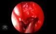 Chirurgie fonctionnelle endoscopique des sinus 