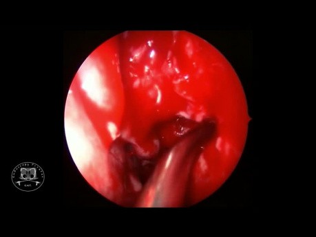 Chirurgie fonctionnelle endoscopique des sinus 