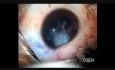 Un autre cas de cataracte traumatique avec rupture du PC