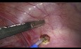 Endométriose