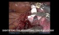 Lobectomie du Lobe Supérieur Gauche Robotisée pour un Cancer Non à Petites Cellules T1 N2 (Non-éditée)