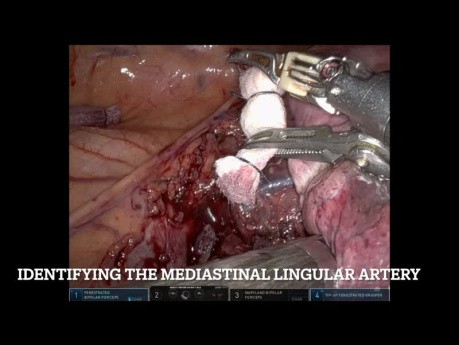 Lobectomie du Lobe Supérieur Gauche Robotisée pour un Cancer Non à Petites Cellules T1 N2 (Non-éditée)