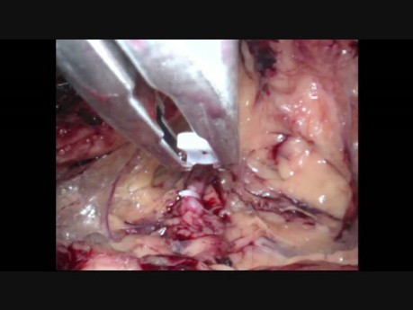 Chirurgie laparoscopique par accès endoscopique unique (LESS)