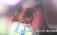 Diverticulotomie - Endoscopie