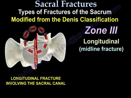 Fractures du sacrum - Classification
