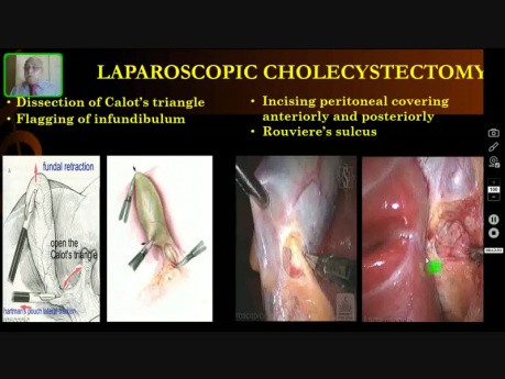 Cholécystectomie laparoscopique