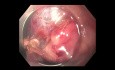 Polype Gastrique Hyperplasique