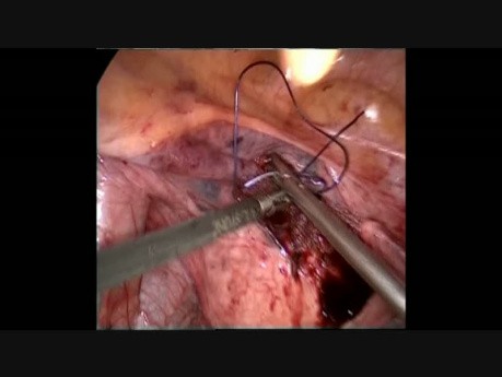 Chirurgie Laparoscopique du Prolapsus des Organes Pelviens 